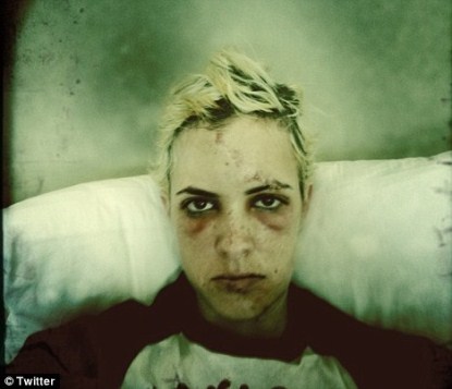 Samantha Ronson Looks Battered and Bruised After Bike Accident
